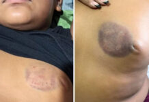 Menino é mordido no peito, agredido por alunos e medicado com antidepressivo após ataques em escola