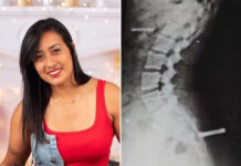 Mulher com fratura no cóccix e liberada de UPA sem diagnóstico será indenizada em R$ 10 mil