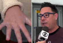 Filhos de cantor Vavá pegam sarna em escola com surto de casos; entenda a doença